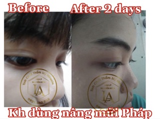 [ HÀNG CAO CẤP ] Tinh chất nâng mũi Pháp Miracle