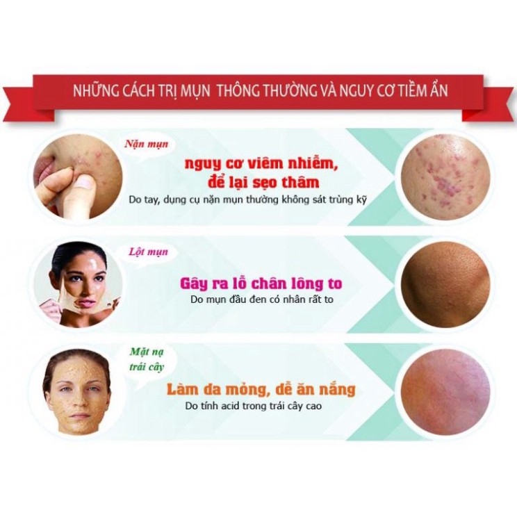 Kem Ngăn Ngừa Mụn Acne Prevention, Dánh Bay Các Loại Mụn, Giúp Làm Mờ Thâm Sạm Da, Se Khít Lỗ Chân Lông, 30g | BigBuy360 - bigbuy360.vn
