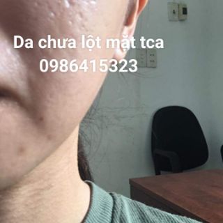 PEEL THAY DA MẶT TCA DÀNH CHO NAM