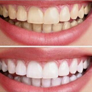 Kem tẩy trắng răng Eucryl