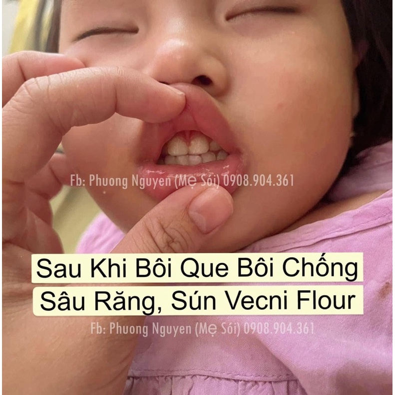 Kem bôi chống sâu răng Mỹ