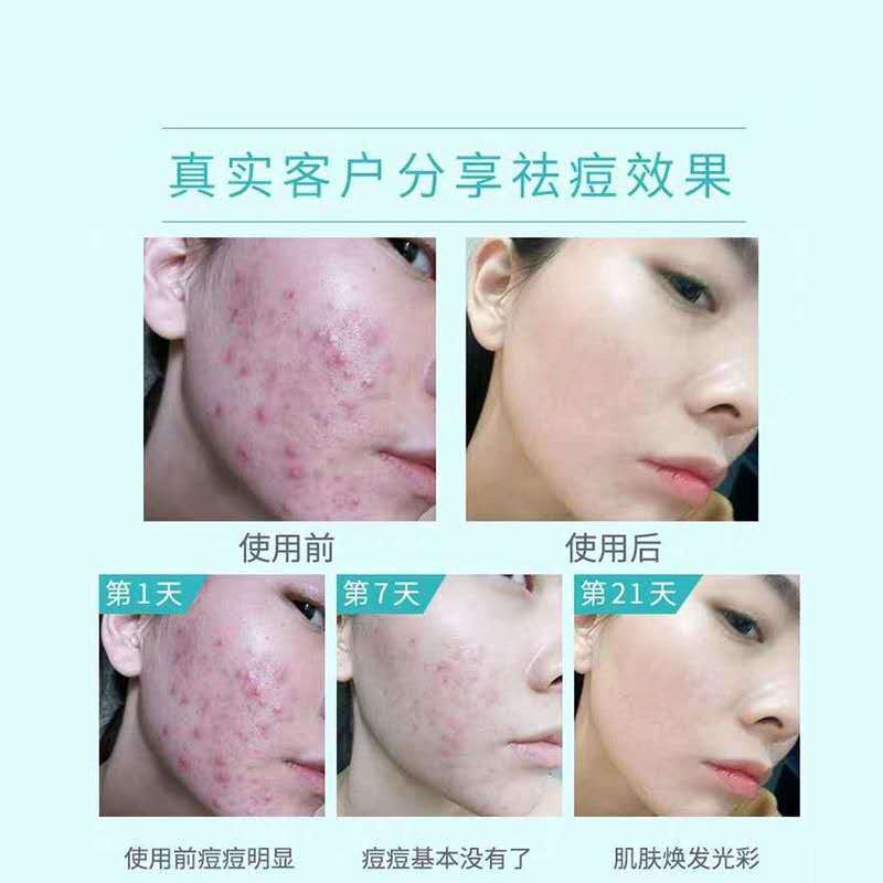 Kem Trị Mụn 20Gmaanshanzanzc.My11.27 Chuyên Dụng Chất Lượng | BigBuy360 - bigbuy360.vn