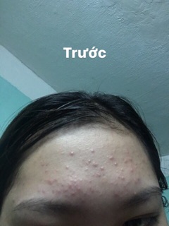 Kem Shiseido pimplit Nhật Bản