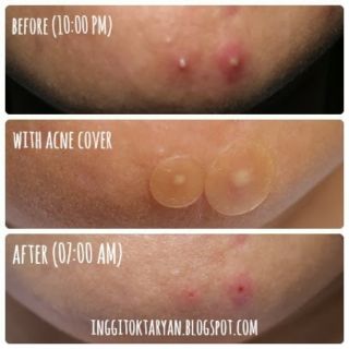 [Combo 2 hộp] Phim dán mụn 3M Nexcare