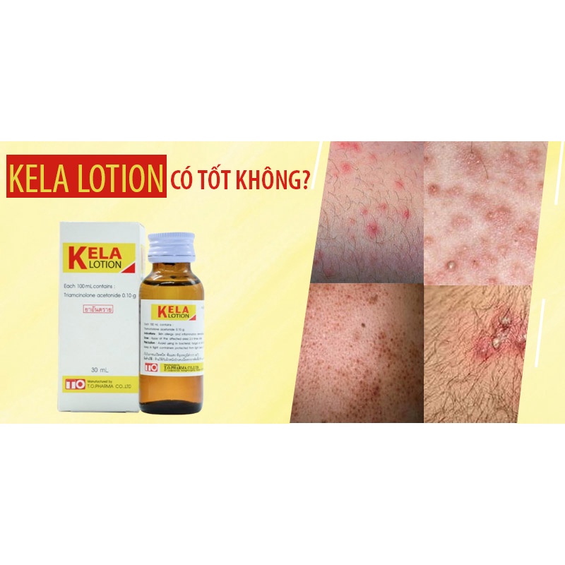 KELA LOTION dưỡng da Chống Viêm Nang, Lỗ Chân Lông 30ml