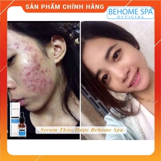 Serum mụn thảo dược Behome spa