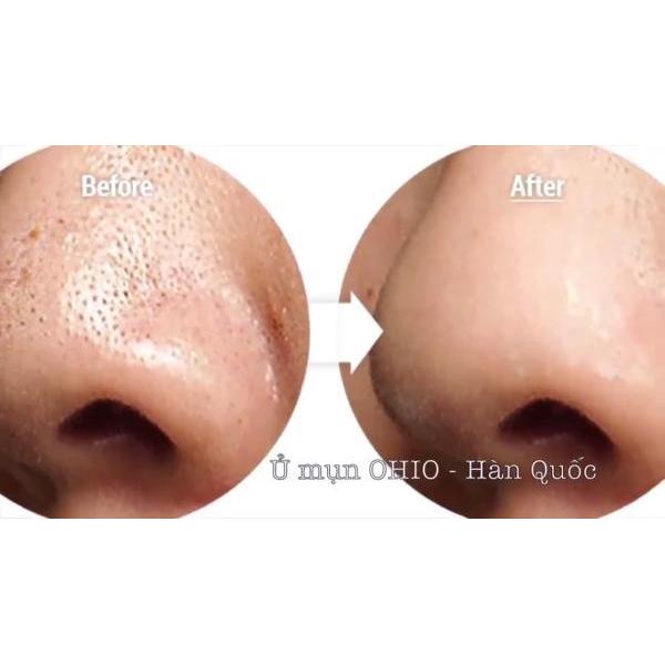 TINH CHẤT Ủ ĐẨY MỤN ĐẦU ĐEN OHIO HÀN QUỐC