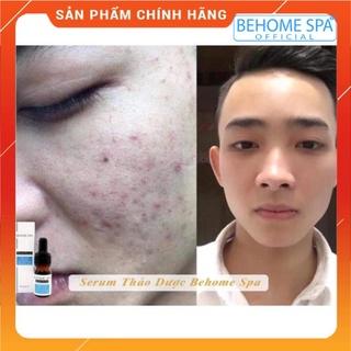 Serum mụn thảo dược Behome spa