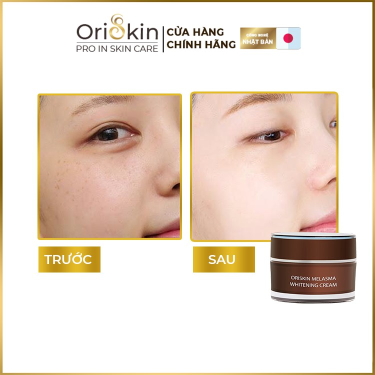 Bộ Kem Nám Tàn Nhang, Dưỡng Trắng, Mờ Thâm, Gồm Kem Oriskin Melasma Whitening Cream Và Serum Oriskin White Skin Serum. | BigBuy360 - bigbuy360.vn