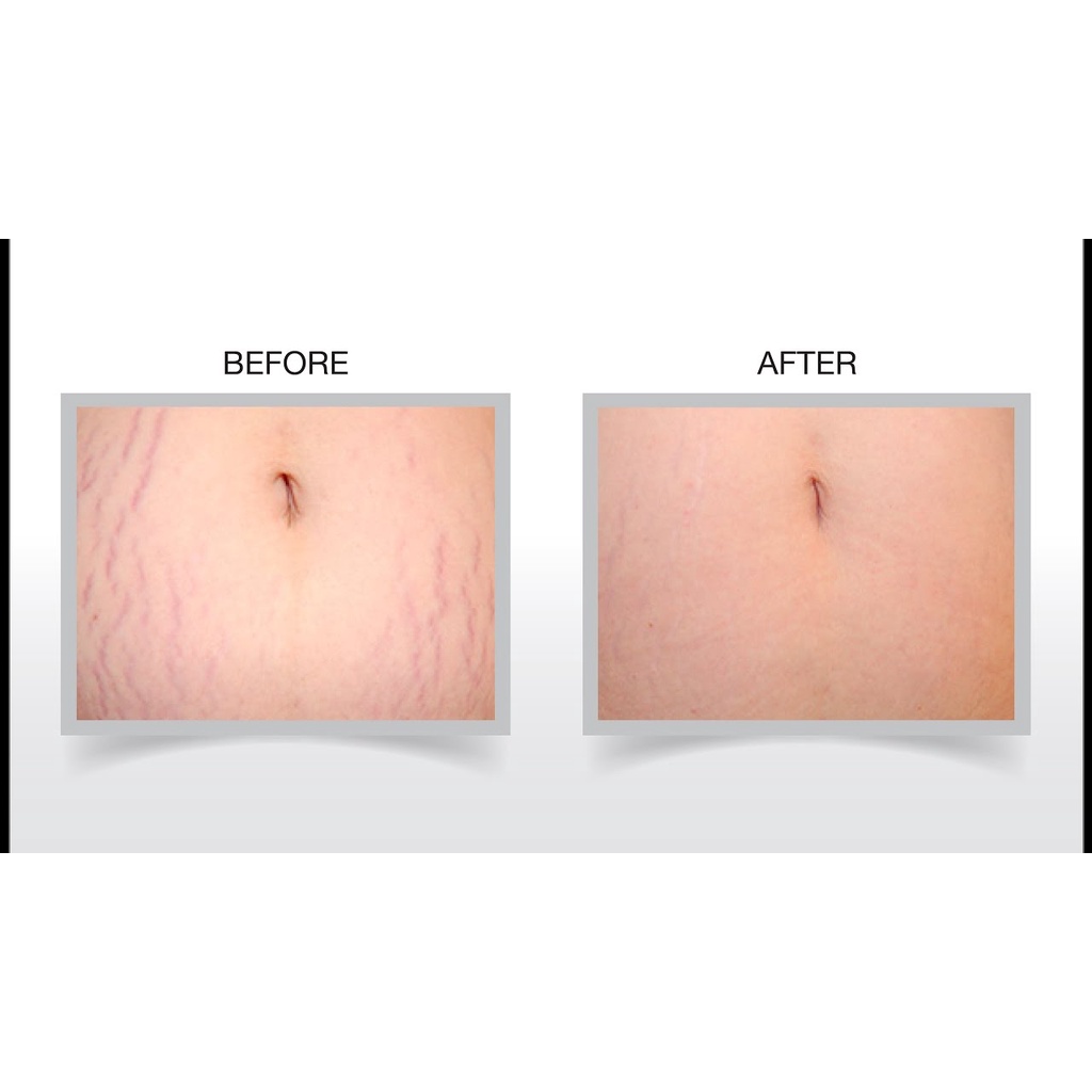 Kem Giảm Rạn Da Đùi Bụng, Làm Mờ Sẹo, Săn Chắc Da RE:P Natural Herb Ultra Firming Stretch Cream 200ml