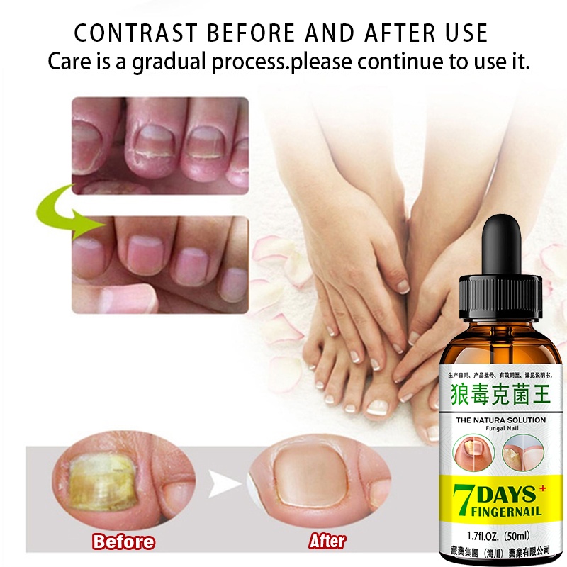 Tinh Chất Hỗ Trợ Giảm Bệnh Nấm Móng Chăm Sóc Móng Tay Tiện Dụng