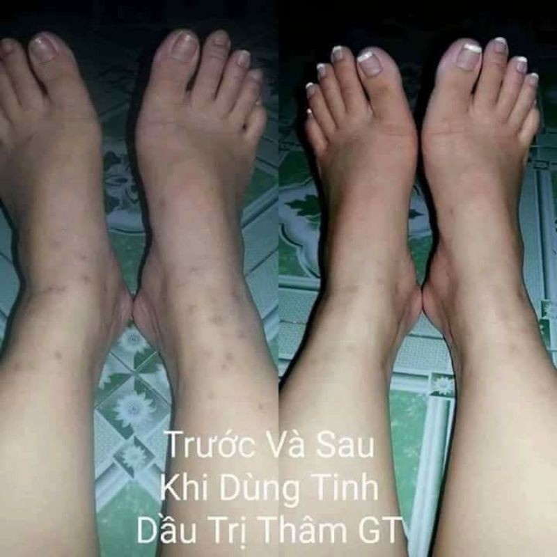 Tinh dầu xóa thâm ngọc thiên hương xóa sạch thâm mụn, mắt, môi, nách - ảnh sản phẩm 4