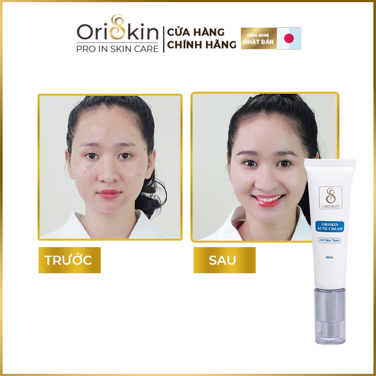 Kem Mụn Oriskin Acne Cream, Xoá Mụn Ẩn Dưới Da, Mụn Viêm Sưng Và Mụn Bọc, 30ml | BigBuy360 - bigbuy360.vn