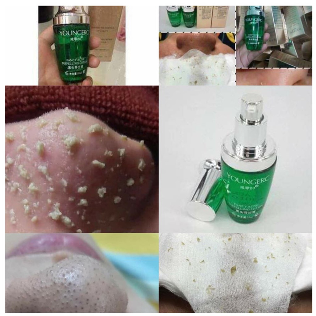 Ủ Mụn Đầu Đen Ủ Mụn Cám Siêu Tốc | BigBuy360 - bigbuy360.vn