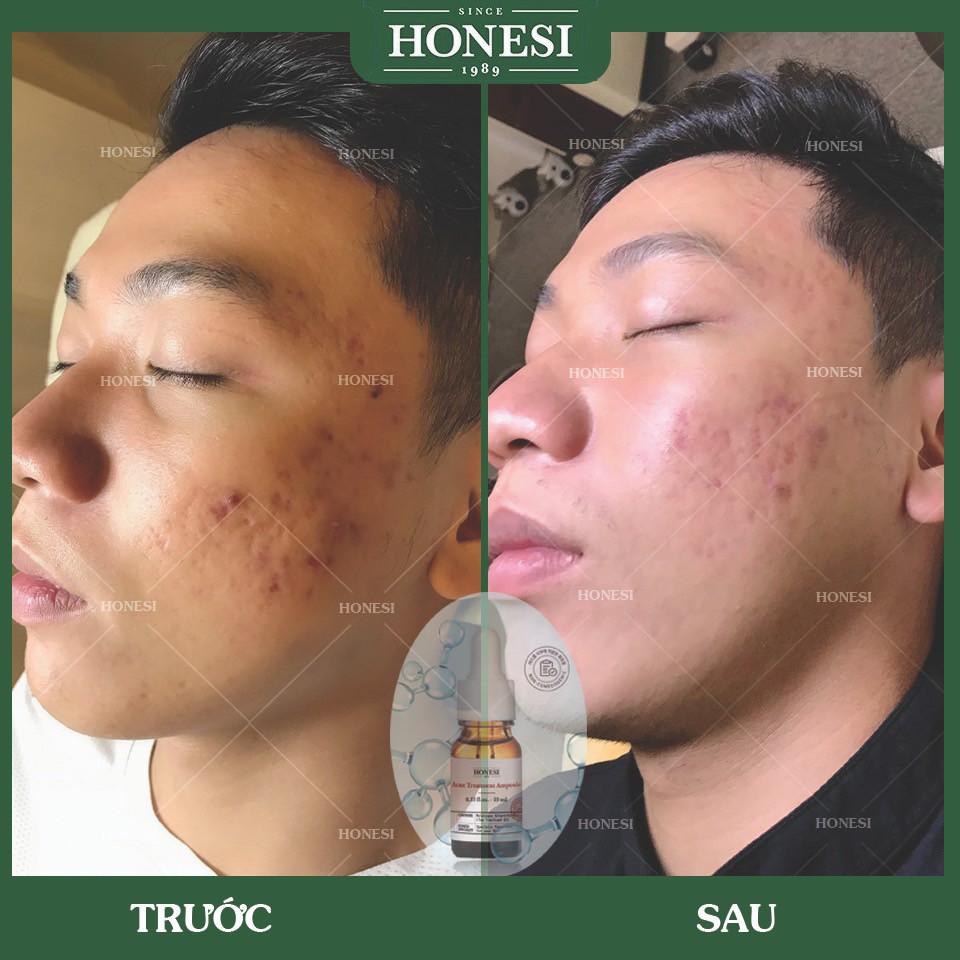 Sét Serum Giảm Mụn Nhanh Lành Tính HONESI Acne Treatment Ampoule (10ml x 5 lọ) - Hàn Quốc BONGSHOPAUTHENTIC | BigBuy360 - bigbuy360.vn