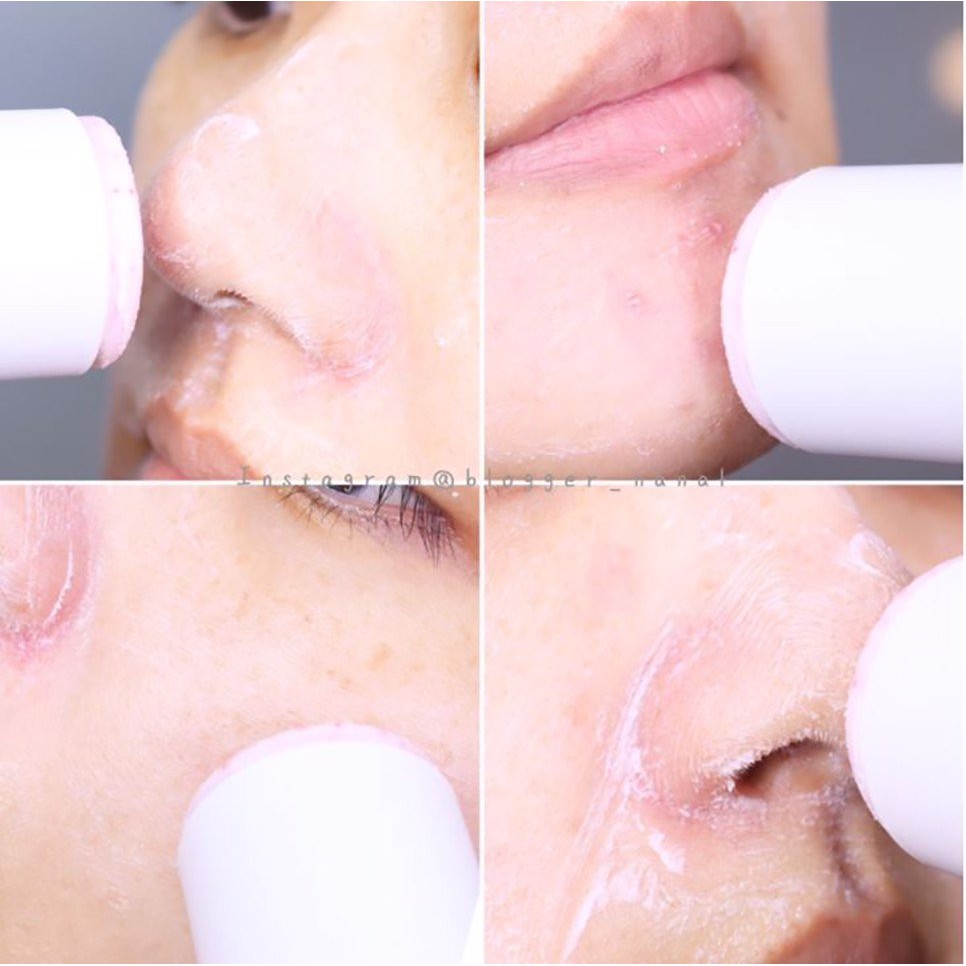 Thanh lăn hỗ trợ giảm mụn đầu đen So’Natural Red Peel Clear Stick