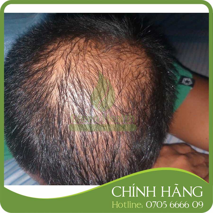 Serum mọc tóc - Minoxidil &amp; Finasteride 10% - Morr F 10% F10 (60ml)
