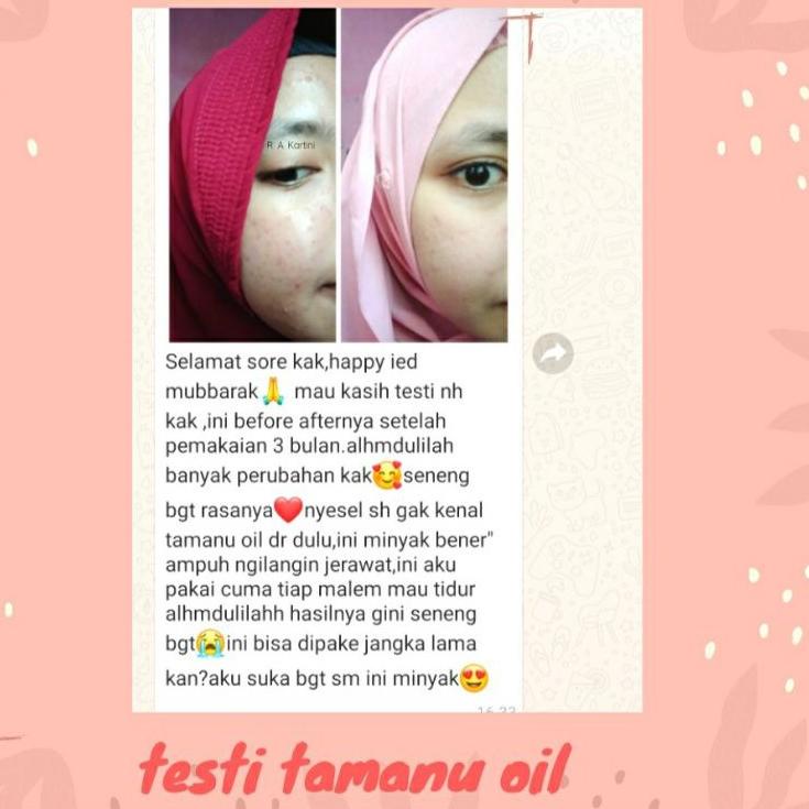 Tinh Dầu Trị Mụn Và Sẹo 5.5 Falabelle Gardenu 30Ml | BigBuy360 - bigbuy360.vn