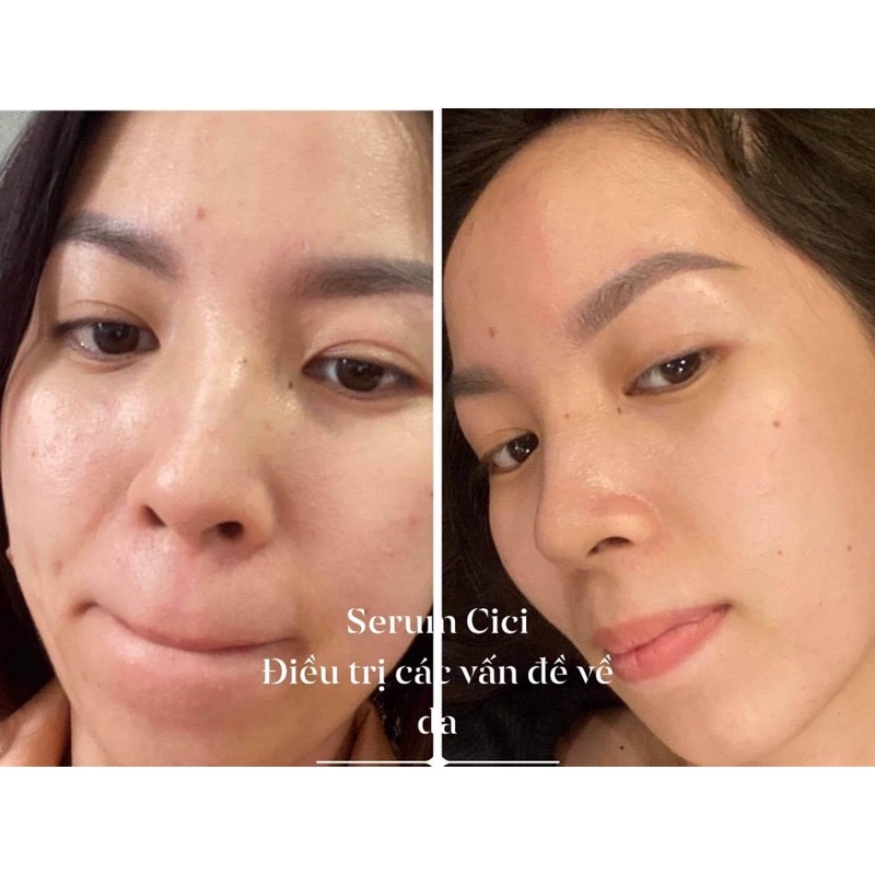 Serum mụn Cici