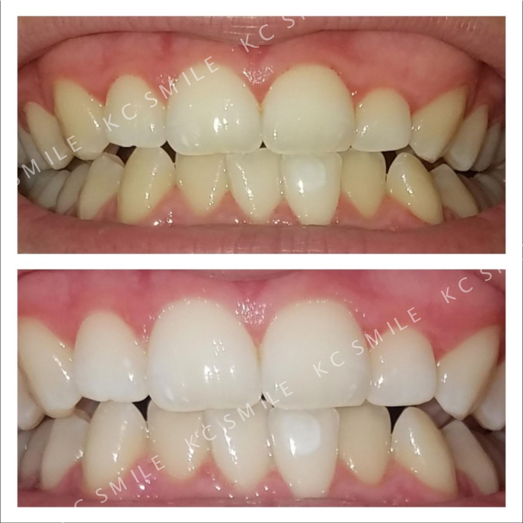 FullBox hộp 21 Gói Miếng dán trắng răng Crest 3D White Supreme FlexFit (Bright) - Độ làm trắng răng cao