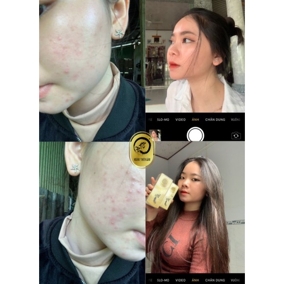 Serum Giảm Mụn Thâm Rỗ - Tinh Chất Hoàng Thiên Sâm 30ml Tái Tạo Da  - Dành Cho Da Chai Lì Khó Hấp