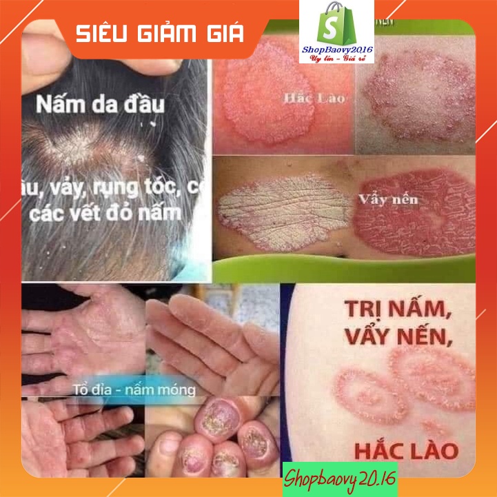 Kem bôi nấm ngứa ★bệnh ngoài da ★ Kem ngoài da, Các vấn đề về da, Cam kết khỏi 100%