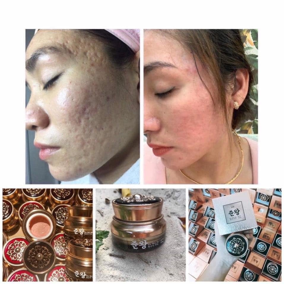 GENIE NON MTS FIX SKIN - KEM ĐÔNG Y GIẢM SẸO RỔ GENIE