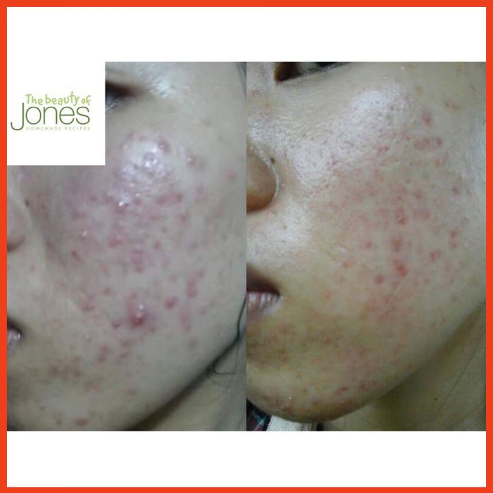 Combo 2 Tuýp Sữa Rửa Mặt Trà Xanh Tảo Biển Cho Da Mụn Nhạy Cảm The Beauty Of Jones