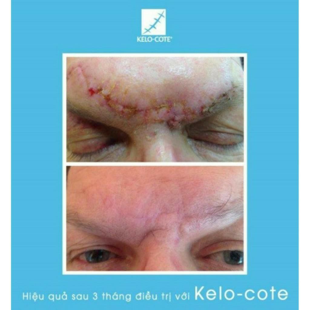 [New 2020] Kem Hỗ Trợ Giảm sẹo Kelo Cote hiệu quả chất lượng cao 15g