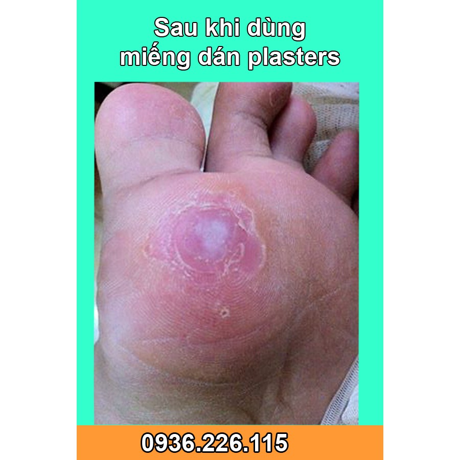 [HÀNG CHÍNH HÃNG] Miếng dán plasters Mụn cóc, Mắt cá chân, Vết chai, Cồi cá, Mụn hạt cơm