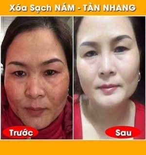 Bộ nám túi thái lan