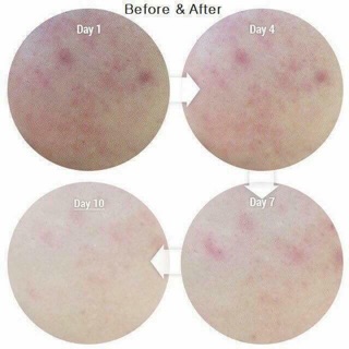 Serum CC melano