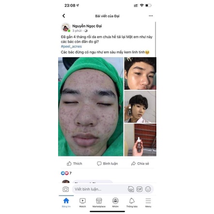 SERUM MỤN ACNES DOCTOR NATUR -
