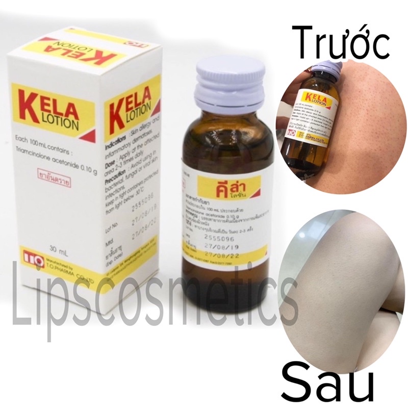 KELA LOTION DÙNG CHO VIÊM LỖ CHÂN LÔNG 30ml Thái Lan