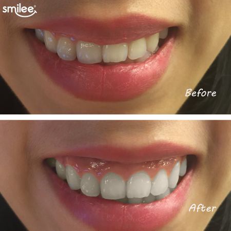 [Full Quà + Sale 30%] Smilee Extra - Tẩy trắng răng tại nhà Smilee cao cấp Extra hiệu quả gấp đôi, rút ngắn còn 10p