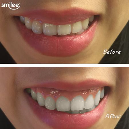 Smilee Extra - Tẩy trắng răng tại nhà Smilee cao cấp Extra hiệu quả gấp đôi, rút ngắn còn 10p