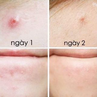 GEL CHẤM MỤN TRÀM TRÀ TBS