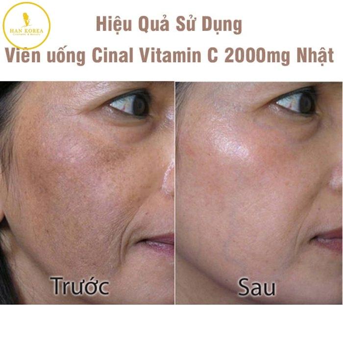 Viên uống Cinal C Nhật Bản, trắng da, mờ thâm nám nám, tăng cường sức khỏe Hân Korea