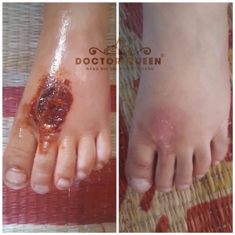 Cao nghệ DOCTOR QUEEN JANG WON mờ thâm liền sẹo nhanh mẫu mới
