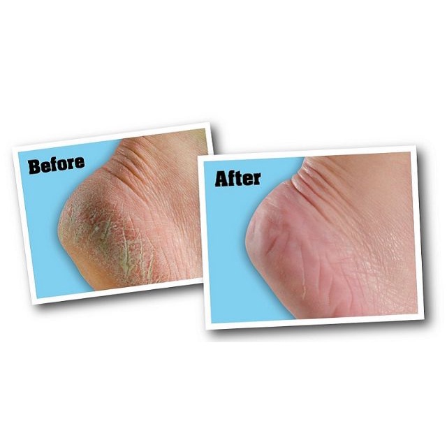 Kem Bôi, Thoa Nứt Nẻ Gót Chân HEEL SPA Thái Lan 20gram - Wincy Mart