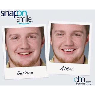 DỤNG CỤ BỌC RĂNG SILICON SNAPON SMILE