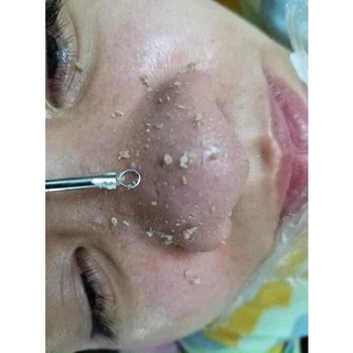 Ủ mụn đầu đen loại 1 mụn cám youngerc 30ml