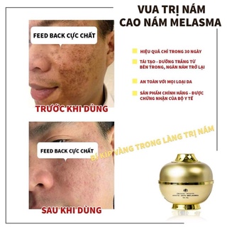 MỜ NÁM SẠM TÀN NHANG CAO NÁM MELASMA