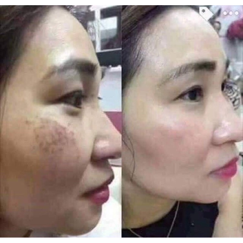 [CAM KẾT CHÍNH HÃNG] Kem Nám Huyền Phi 30g
