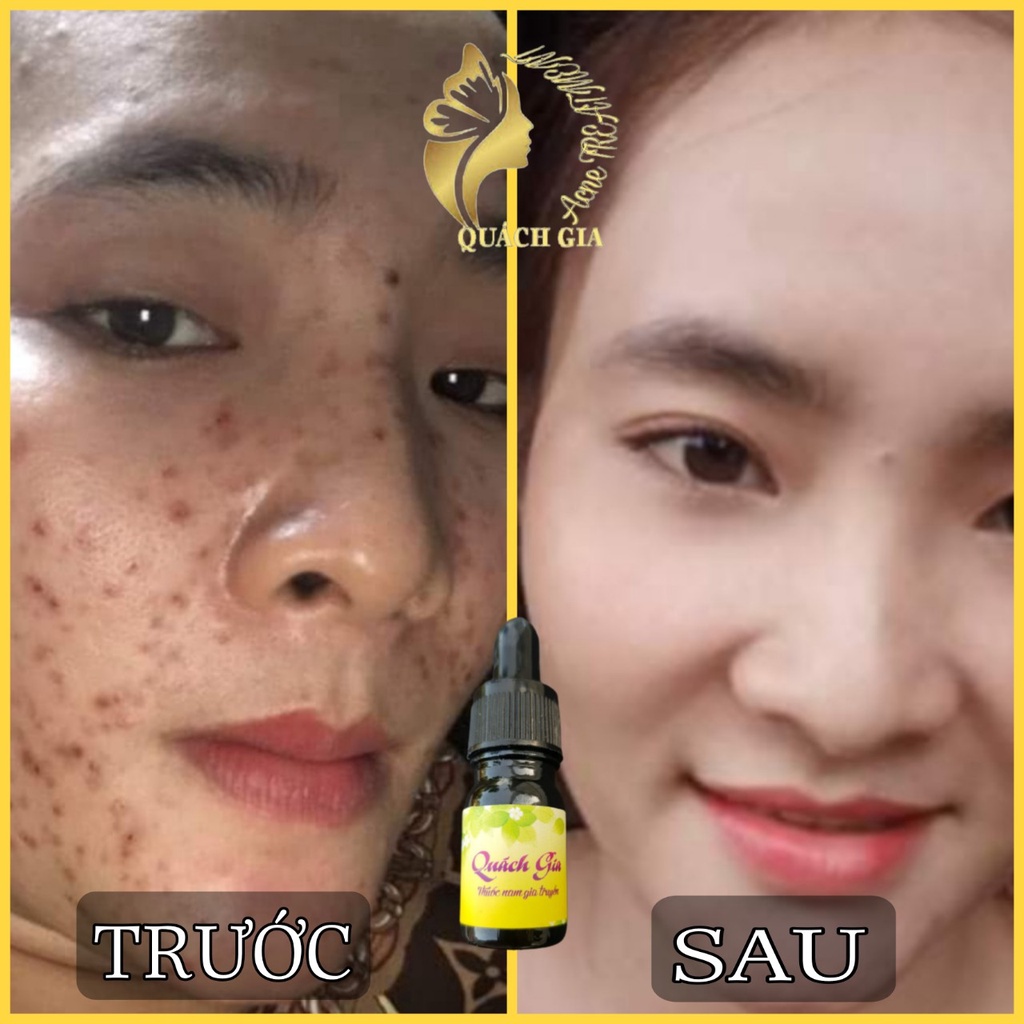 Quách Gia - Sạch mụn thâm và dưỡng da - Sản phẩm hiệu quả