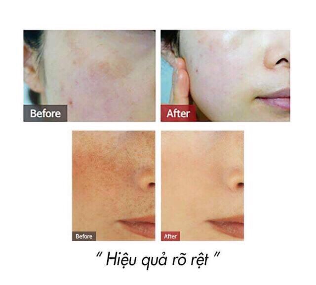 Kem làm giảm và ngăn ngừa nám Melasma 3D white clinic cream