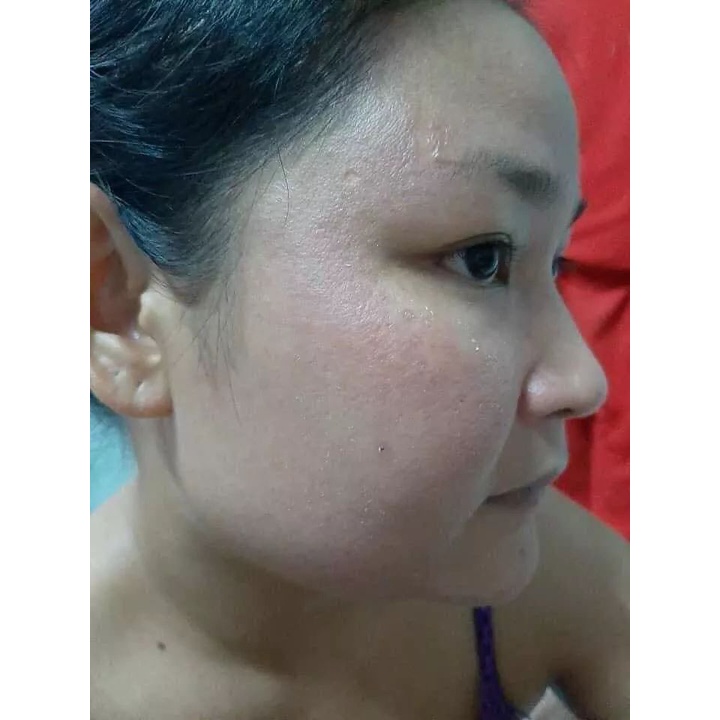 Chấm mụn nám tàn nhang lấp đầy sẹo rỗ 7 ngày bong Nám mụn ruồi 1ml