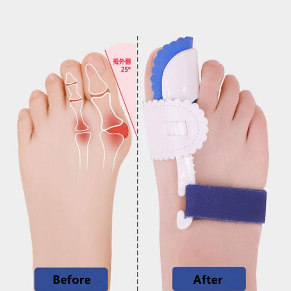 [Hàng mới về] Cặp dụng cụ nẹp tách chỉnh sửa ngón chân cải thiện biến dạng ngón chân cái cố định vòm giữa bàn chân