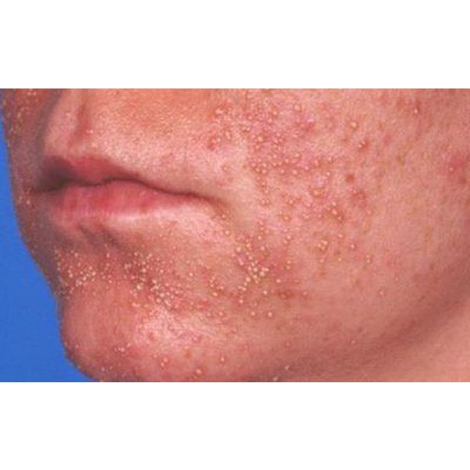 Thảo dược đánh bay Da sần sùi, thô ráp, Viêm lỗ chân lông, Lông quặp , Viêm nang lông