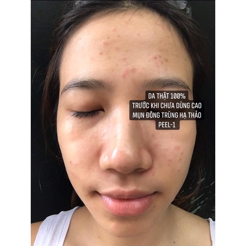 SỈ GIÁ ĐẸP NHẤT -  Cao mụn ĐÔNG TRÙNG HẠ THẢO  PEEL ONE